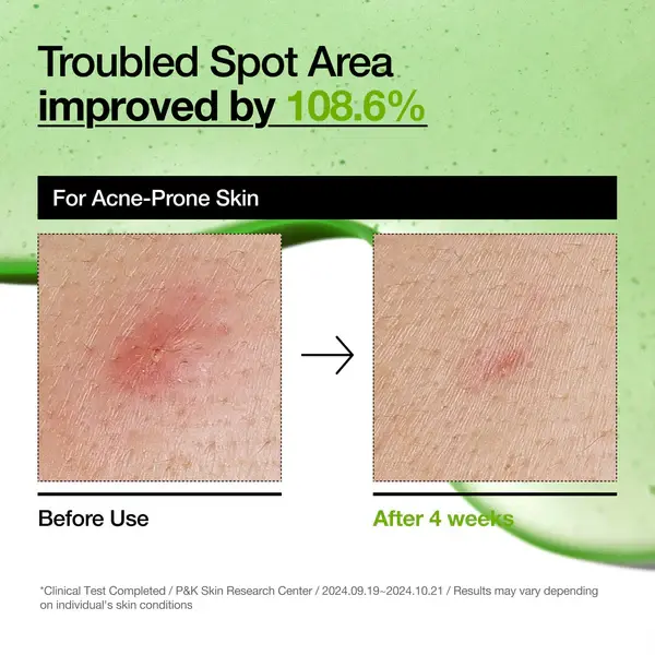 anua-us-ampoule-serum-azelaic-acid-10-hyaluron-redness-soothing-serum-1161173132.webp