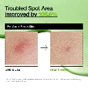 anua-us-ampoule-serum-azelaic-acid-10-hyaluron-redness-soothing-serum-1161173132.webp