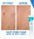 acne-control-gel-ba2-desktop-700x785-v1.webp